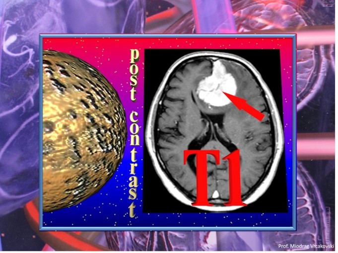 MRI CONTRAST AGENTS IN NEURORADIOLOGY – HOW THEY ACT! – Easy Neuroradiology