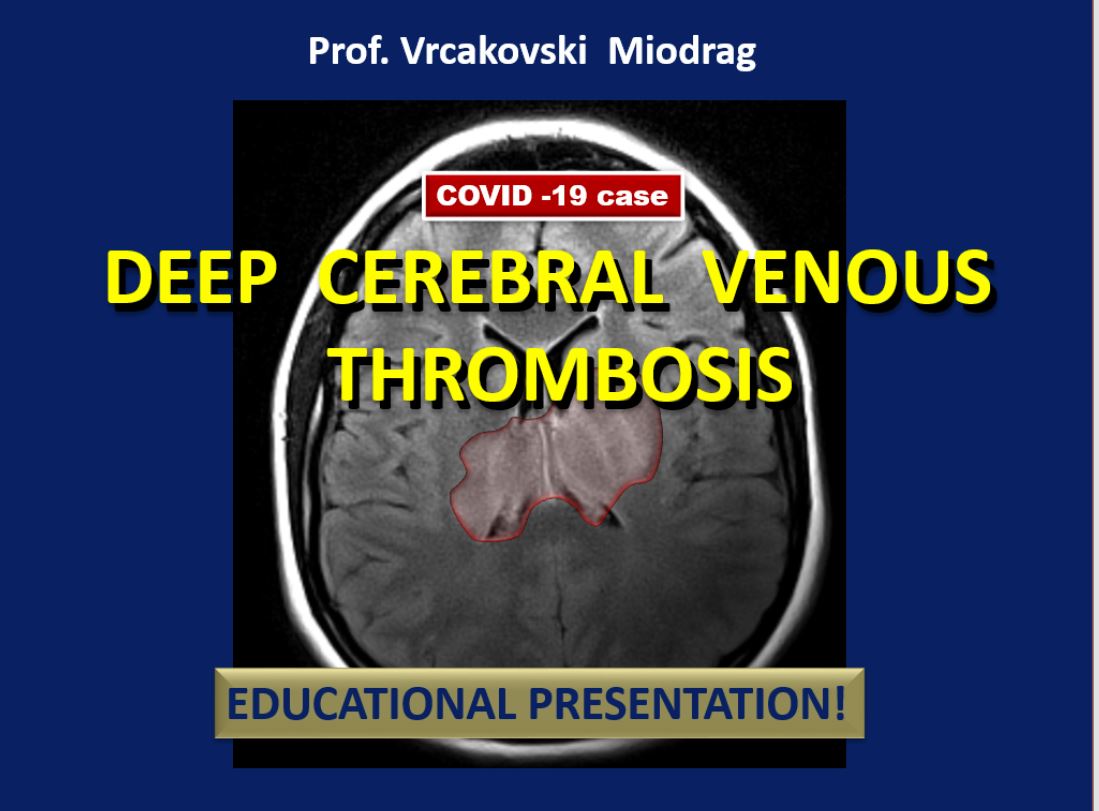 Deep Cerebral Venous Thrombosis Thumbnail